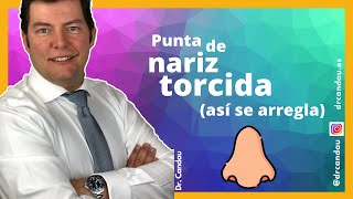 Rinoplastia Ultrasónica Ambulatoria - Punta de la nariz torcida (así se arregla)