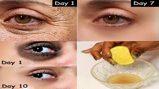 In 3 days remove under eye bag look younger forever