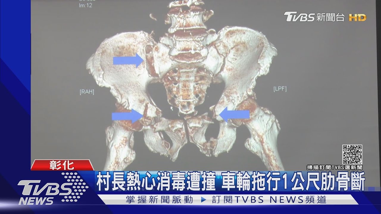 村長熱心消毒遭撞 車輪拖行1公尺肋骨斷
