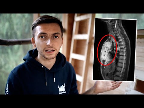 Ich beantworte eure Fragen zu meinem Tumor