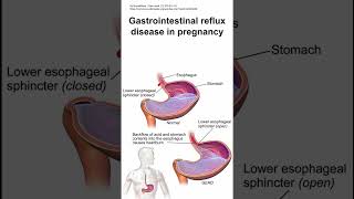 Gastrointestinal reflux disease in pregnancy