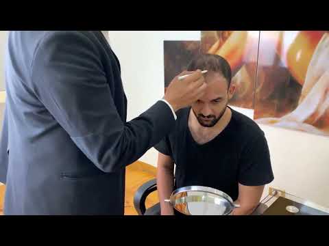  خطوات زراعة الشعر للبلوجر عبدلله السويدي مع د.أحمد مكاوي