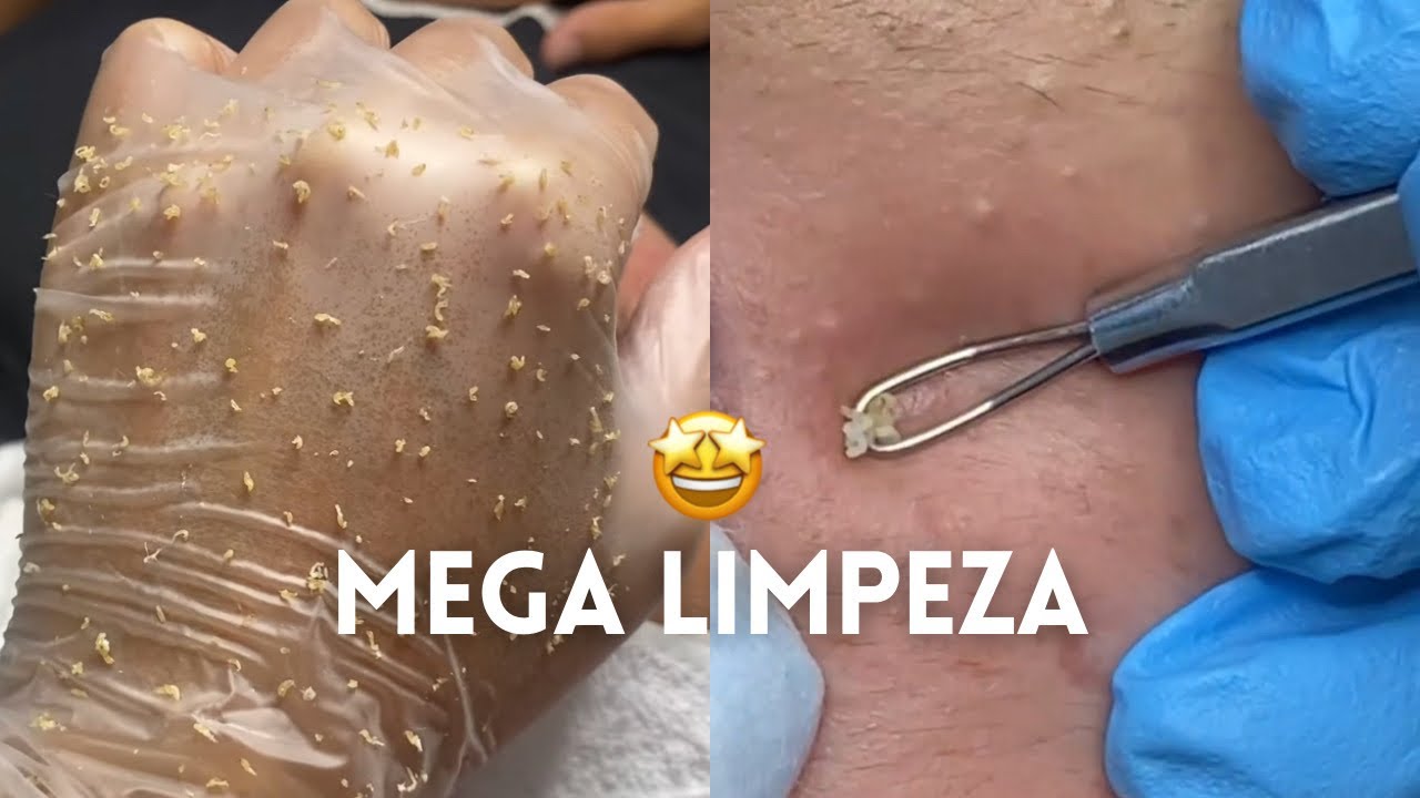 A maior EXTRAÇÃO que já fiz | Limpeza de pele em adolescente completa