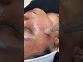 Derma Pen For Removing Acne Scars