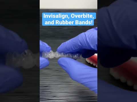 Invisalign, Overbite, and Rubber bands!