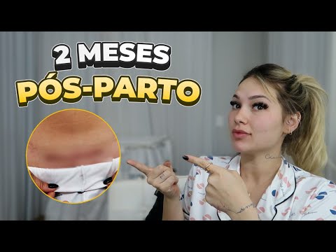 MOSTREI MINHA CICATRIZ PÓS-PARTO!!