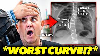 **WORST POSTURE** GETS 'STRAIGHTENED' AFTER 15 YEARS! 😱 | Asmr Chiropractic Back Crack | Dr Tubio
