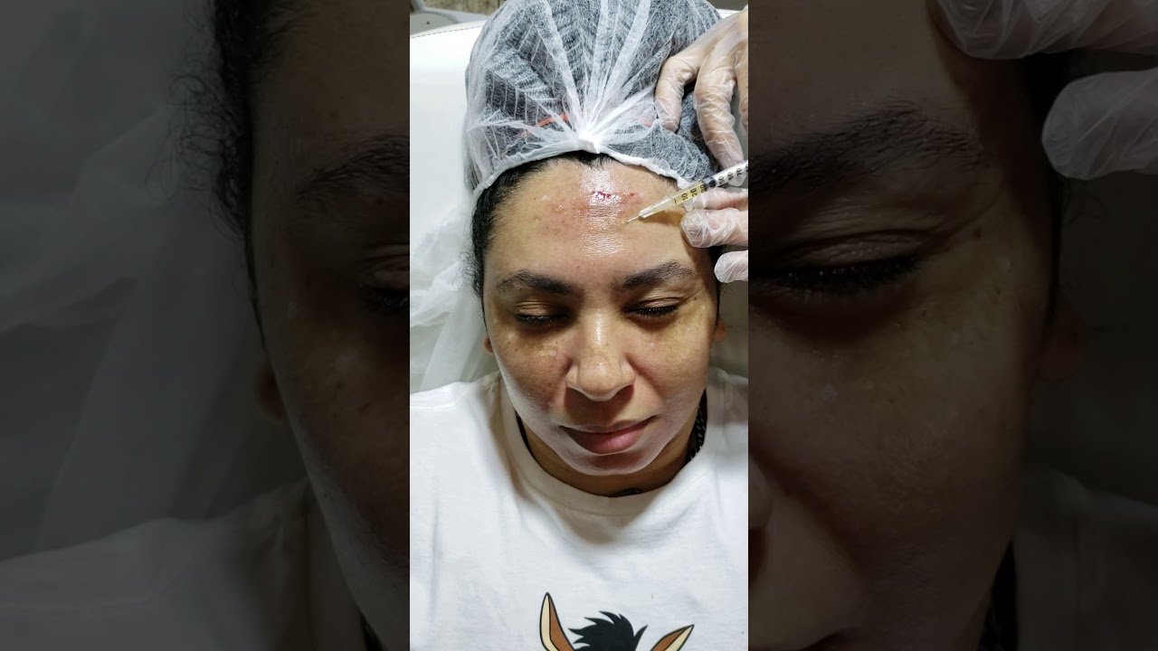 Minha experiência com o PRP no rosto!