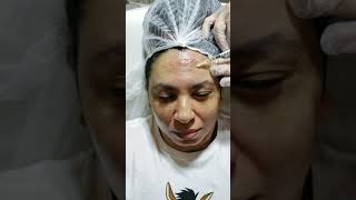 Minha experiência com o PRP no rosto!