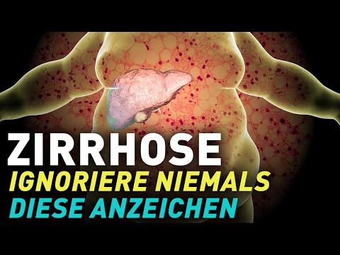 Leberzirrhose: Diese Symptome NIEMALS ignorieren!