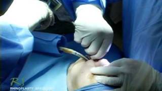 Dr. Nassif’s Closed Rhinoplasty How To – Fracturing Nasal Bone