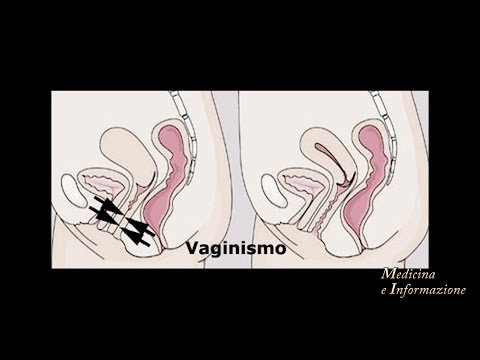 Giunti goleno-astragalica Collo miosite dà dolore alla gola