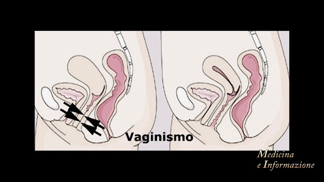 Vaginismo e Vulvodinia: sintomi e cause dolore pelvico cronico e nei rapporti