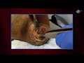 WCW: Natural Maggot Therapy - WebCME WCW: Natural Maggot Therapy