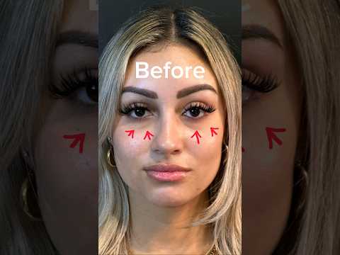 Correcting under eye bags/ dark circles with PRP filler