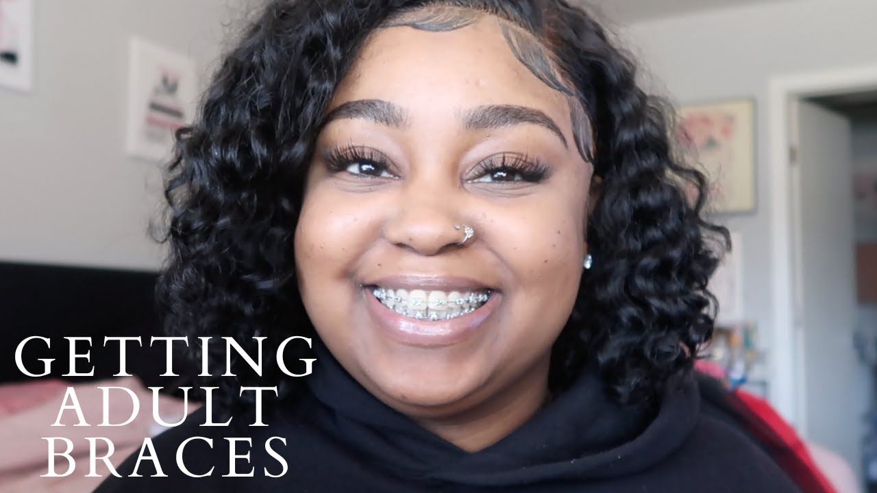 ADULT BRACES | GETTING MY BRACES PT 3 | MY EXPERIENCE