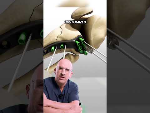 Surgery (often) Required: Tibial Plateau ORIF #shorts