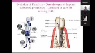 Q&A Webinar - CT scan guide for Dental Implants | 19th July 2022