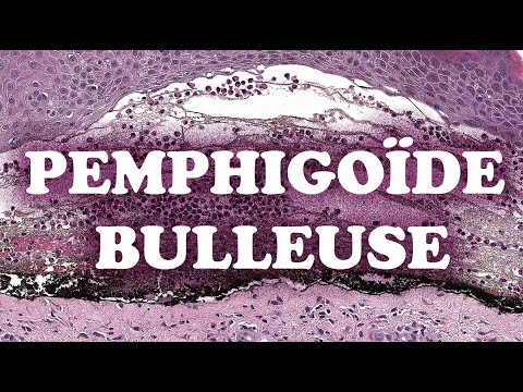 LA PEMPHIGOÏDE BULLEUSE - PATHOLOGIE