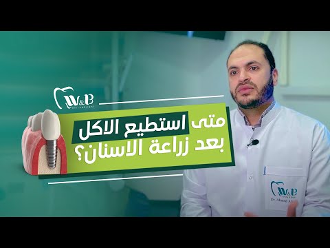 متى استطيع الاكل بعد زراعة الاسنان