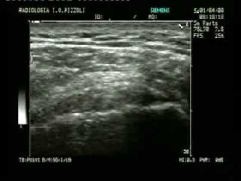 Mostrare la struttura dellarticolazione della spalla Impianti in titanio per giunti