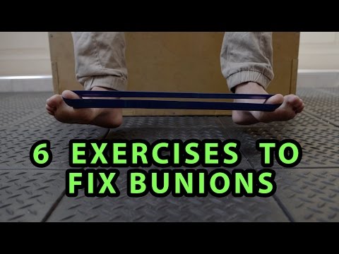6 Exercises to Fix Bunions