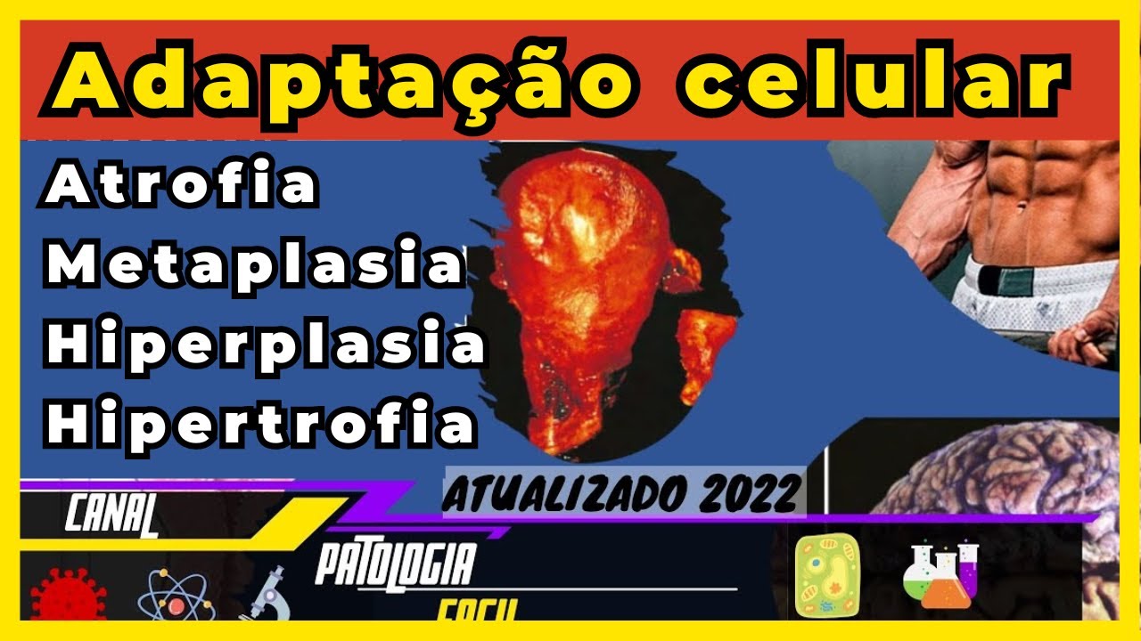 Adaptação Celular: Hipertrofia, Hiperplasia, Hipotrofia, Metaplasia (Patologia) [atualizado]