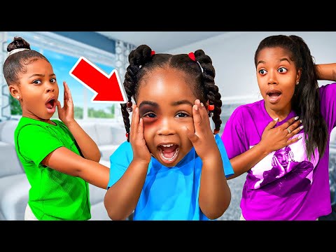 AMORA HAS A BLACK EYE