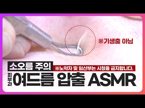 여드름 압출 ASMR - 화농성 여드름 부터 좁쌀 여드름 까지 피부과에서 압출하는 과정