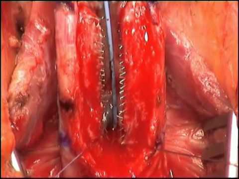 Recurrent Anterior Urethral Strictures (Stent Failure) - Management