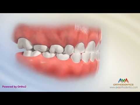 Malocclusion - Underbite or Crossbite with Functional Shift