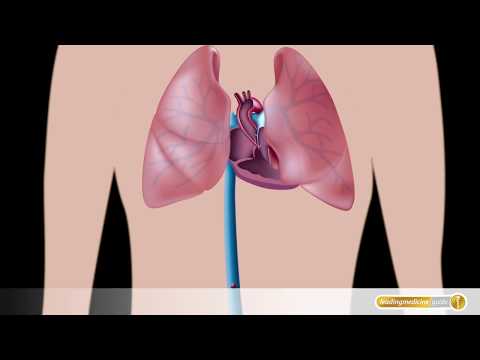 Lungenembolie: Wanderndes Blutgerinnsel im Körper