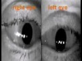 Eye Movevement Examples