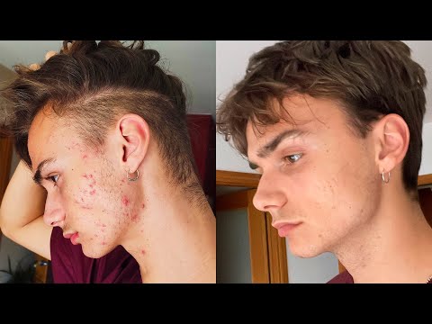 , title : 'Como quitar el acné (Guía sin tonterías)'