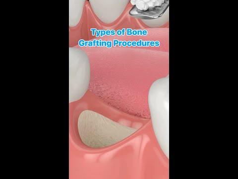 Bone Grafting