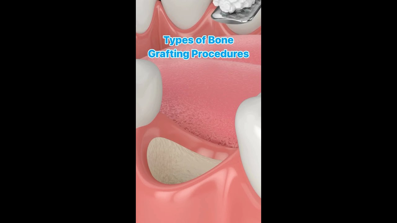 Bone Grafting