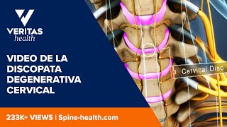 Video de la discopata degenerativa cervical