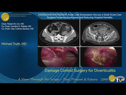 Cirugía de control de daños para diverticulitis