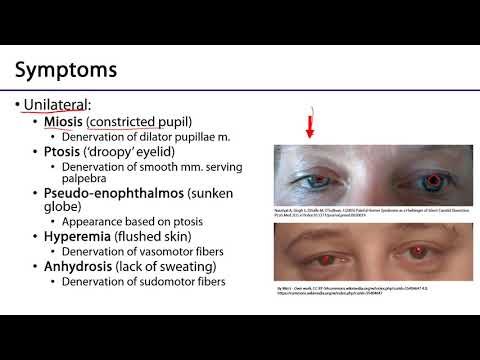 Larynx, Pharynx and CST LO 11 - Horner's Syndrome