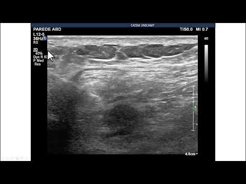 Biópsia por agulha grossa, guiada pela US, de recidiva peritoneal de carcinoma de ovário.