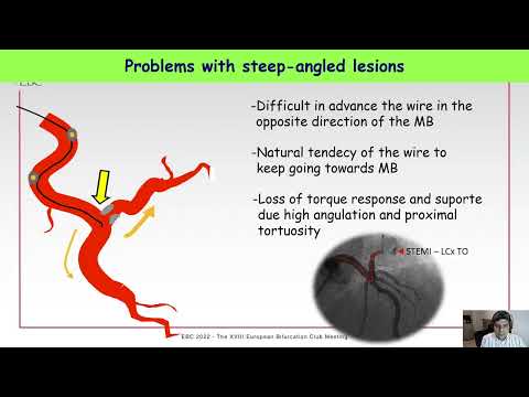 Techniques and advance manoeuvres for difficult SB access - Dr Evandro Martins