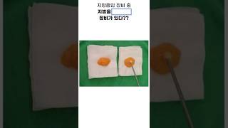 베이저 지방흡입 성형 시술