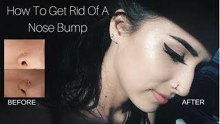 How I Got Rid of a "Nose Piercing Bump" in ONE WEEK! (UPDATE)