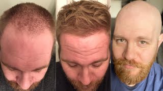 THIS GUY COMPLETELY REVERSED HAIR LOSS BUT WENT BALD AGAIN. HERE’S WHY.