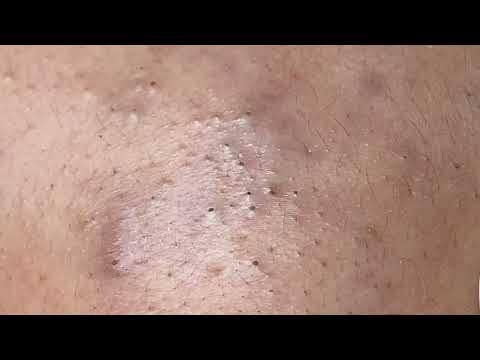 Ultimate Blackhead Removal * ASMR Relaxation *