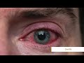 Uveitis Explained Eye Inflammation Symptoms Treatment By Dr Tanya Jain