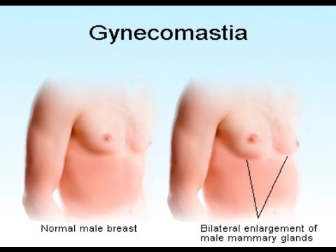 Gynecomastia