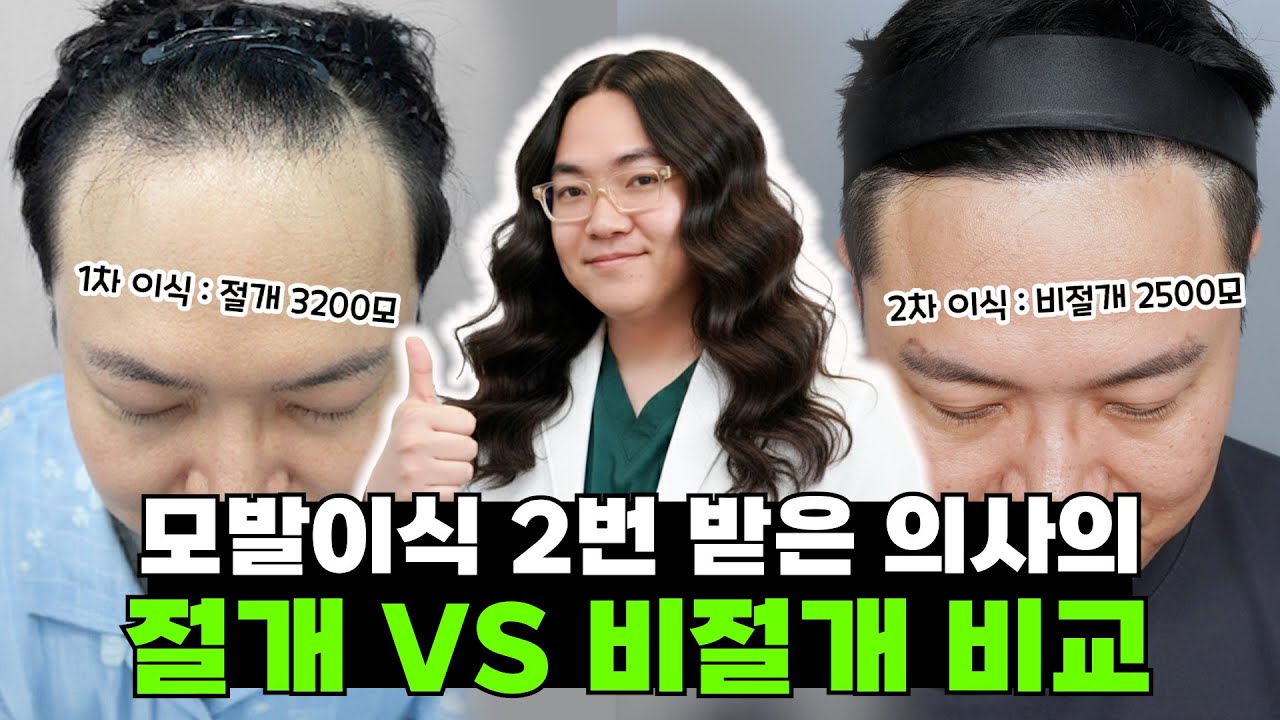 모발이식 절개, 비절개 전부 수술받아 본 의사의 이식방법 비교
