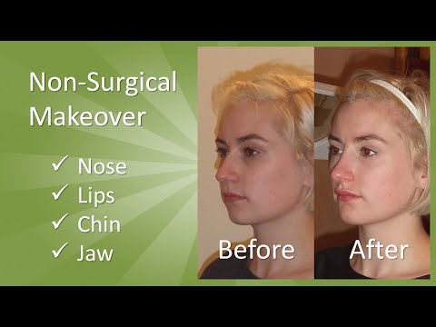 Non Surgical Makeover: Nose, Lips, Chin, Jaw