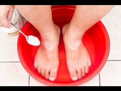El tratamiento del hongo de uña por la tintura del propóleos las revocaciones El tratamiento láser del hongo de la uña del precio